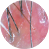 Scalp Sensitivity