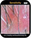 Scalp Sensitivity